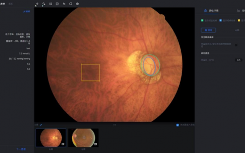 腾讯获批创新医疗器械 AI辅助有望解决青光眼诊断难题